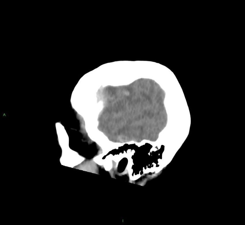 Cerebral amyloid angiopathy-associated lobar intracerebral hemorrhage (Radiopaedia 58752-65973 C 46).jpg