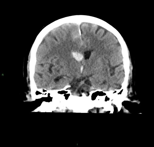 File:Cerebral amyloid angiopathy-associated lobar intracerebral hemorrhage (Radiopaedia 59356-66716 Coronal non-contrast 36).jpg
