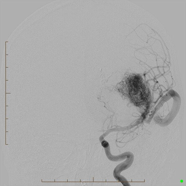 File:Cerebral arteriovenous malformation (AVM) (Radiopaedia 78162-90707 C 9).jpg