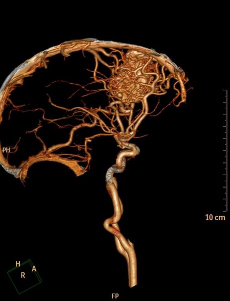 File:Cerebral arteriovenous malformation (Radiopaedia 29531-30031 B 6).jpg