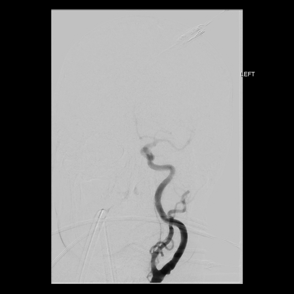 File:Cerebral arteriovenous malformation with lobar hemorrhage (Radiopaedia 44725-48513 LT CCA IC 10).png