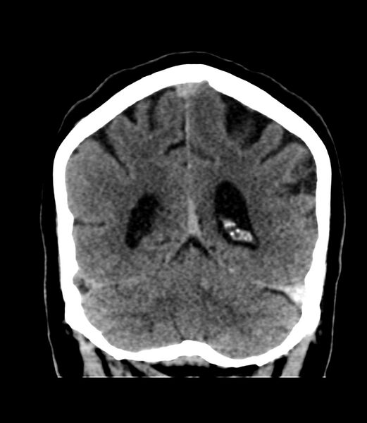 File:Cerebral dural venous sinus thrombosis (Radiopaedia 86514-102575 Coronal non-contrast 38).jpg