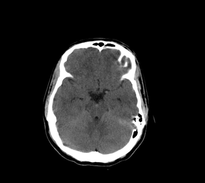 File:Cerebral fat embolism (Radiopaedia 37510-39362 Axial non-contrast 13).jpg
