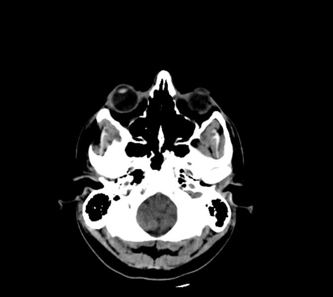 File:Cerebral fat embolism (Radiopaedia 37510-39362 Axial non-contrast 7).jpg