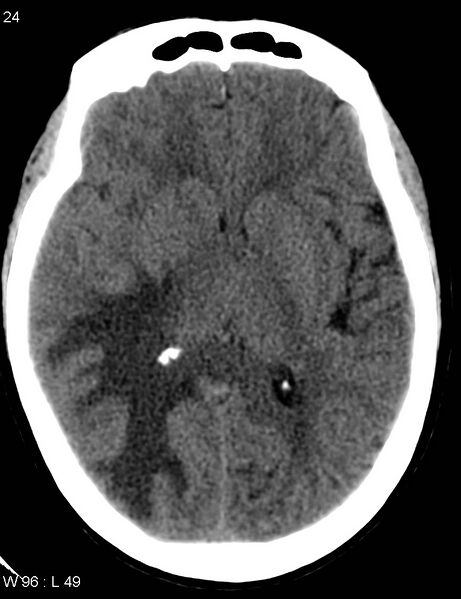 File:Cerebral metastasis - lung cancer (Radiopaedia 5315-7072 Axial non-contrast 3).jpg