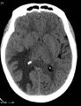 Cerebral metastasis - lung cancer (Radiopaedia 5315-7072 Axial non-contrast 3).jpg