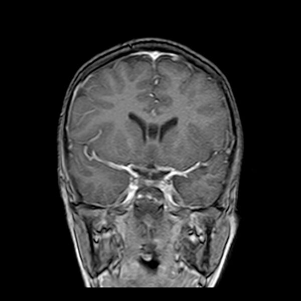 File:Cerebral tuberculoma (Radiopaedia 41152-43932 Coronal T1 C+ 7).jpg