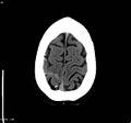 Cerebral vein thrombosis (Radiopaedia 4408-6628 Axial non-contrast 5).jpg