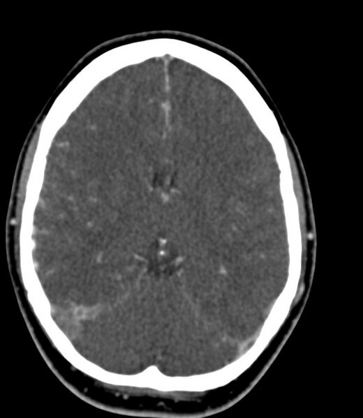 File:Cerebral venous sinus thrombosis (Radiopaedia 59224-66646 Axial C+ delayed 28).jpg