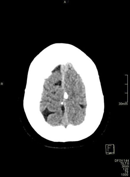 File:Cerebral venous sinus thrombosis (Radiopaedia 91329-108965 Axial non-contrast 45).jpg