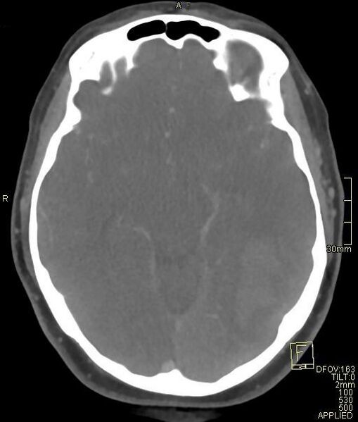 File:Cerebral venous sinus thrombosis (Radiopaedia 91329-108965 Axial venogram 36).jpg