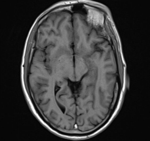 File:Cerebral venous thrombosis (Radiopaedia 71207-81504 Axial T1 12).jpg