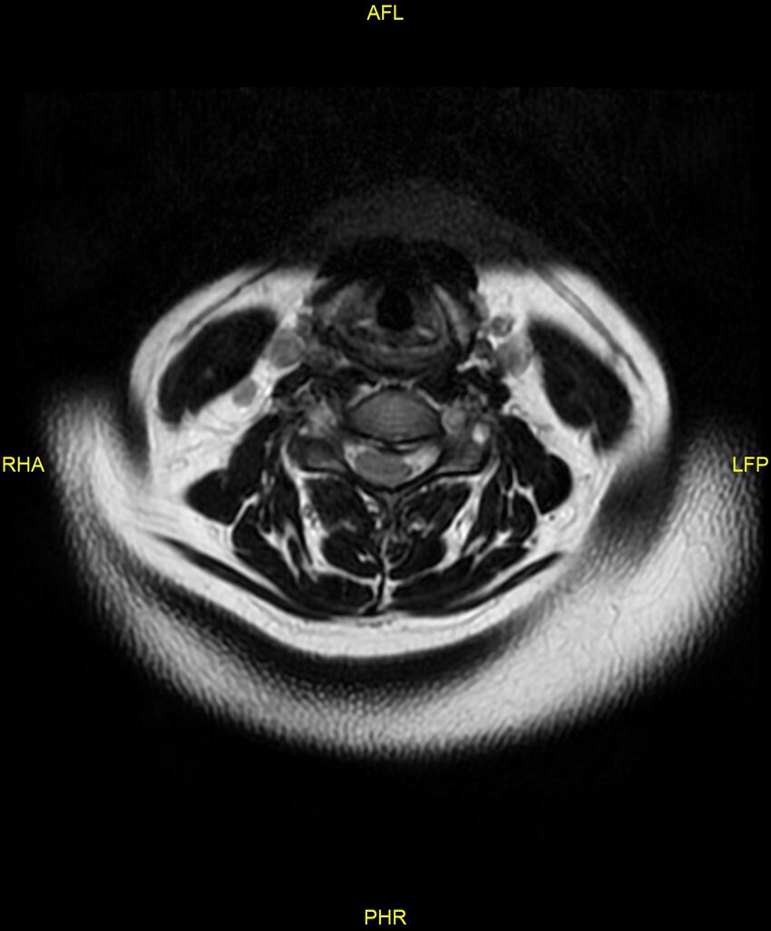 Cervical disc protrusion (Radiopaedia 87147-103415 Axial T2 17).jpg