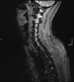 Cervical dural CSF leak on MRI and CT treated by blood patch (Radiopaedia 49748-54995 D 2).png