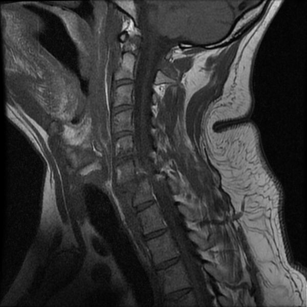 File:Cervical fracture and dislocation with locked facet (Radiopaedia 31837-32781 Sagittal T1 10).jpg