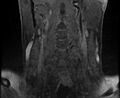 Cervical schwannoma (Radiopaedia 72399-82934 G 3).jpg