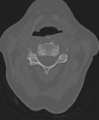 Cervical spine ACDF loosening (Radiopaedia 48998-54071 Axial bone window 26).png
