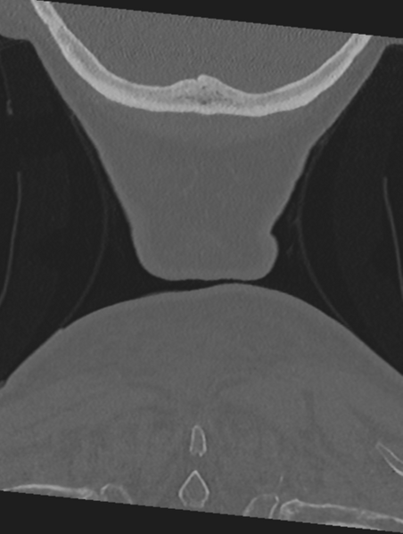 File:Cervical spondylolysis (Radiopaedia 49616-54811 Coronal bone window 66).png