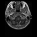 Cervical vertebrae metastasis (Radiopaedia 78814-91667 Axial T1 14).png