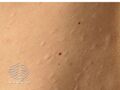 Chickenpox scars (DermNet NZ dermal-infiltrative-s-anetoderma02).jpg