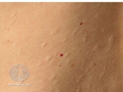 Chickenpox scars