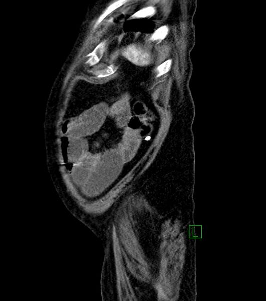 File:Cholangiocarcinoma with cerebral metastases (Radiopaedia 83519-98629 F 16).jpg