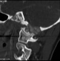 Chondroblastoma - occipital condyle (Radiopaedia 5569-7304 Sagittal bone window 1).jpg