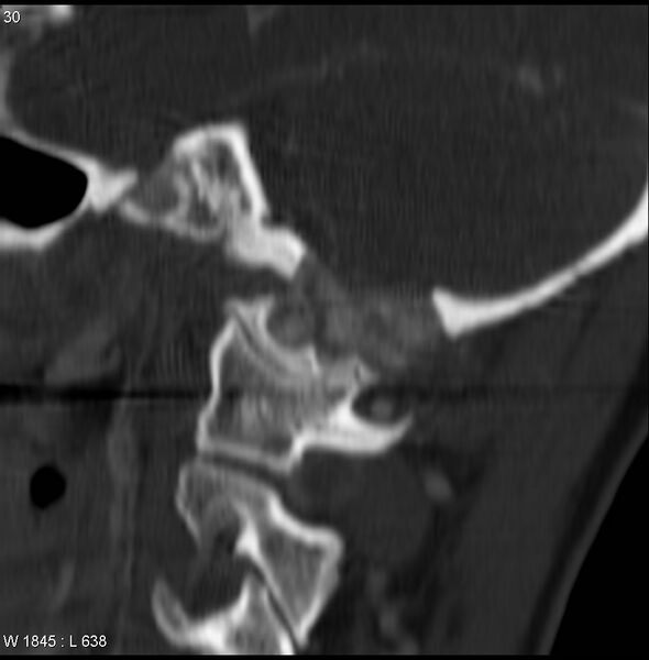 File:Chondroblastoma - occipital condyle (Radiopaedia 5569-7304 Sagittal bone window 1).jpg