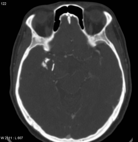 File:Chondrosarcoma - sphenoid wing (Radiopaedia 5421-7174 Axial bone window 8).jpg