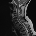 Chordoma (C4 vertebra) (Radiopaedia 47561-52189 Sagittal T2 7).png