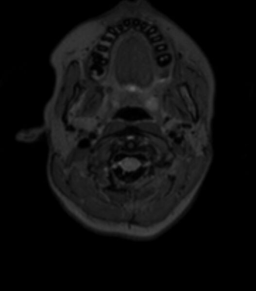 File:Choroid plexus carcinoma (Radiopaedia 91013-108553 Axial T2 fat sat 20).jpg