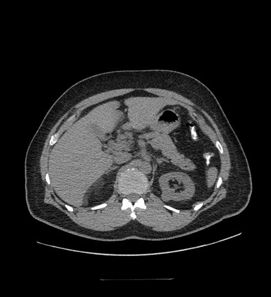File:Chromophobe renal cell carcinoma (Radiopaedia 84337-99644 Axial non-contrast 29).jpg