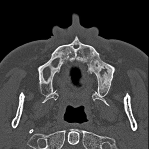 File:Chronic maxillary sinusitis (Radiopaedia 27879-28116 Axial bone window 5).jpg