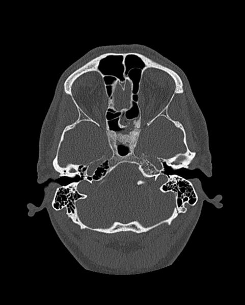 File:Chronic maxillary sinusitis caused by a foreign body (Radiopaedia 58521-65676 Axial bone window 229).jpg