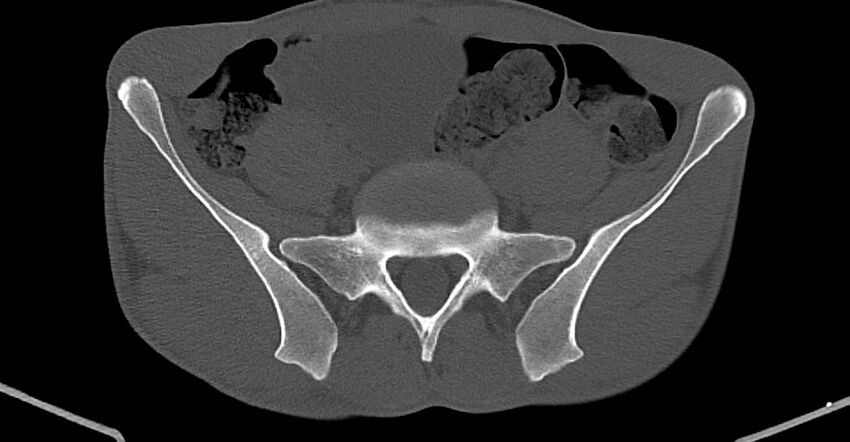 Chronic osteomyelitis (with sequestrum) (Radiopaedia 74813-85822 Axial non-contrast 1).jpg