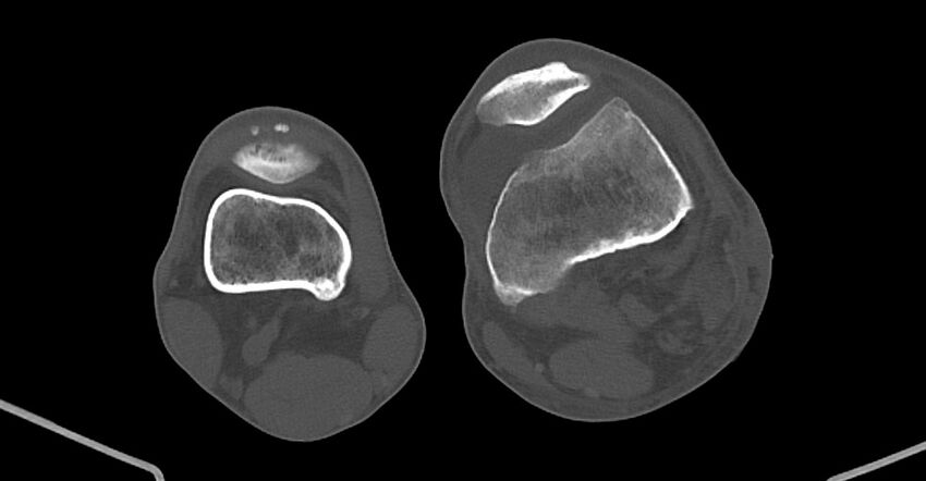 Chronic osteomyelitis (with sequestrum) (Radiopaedia 74813-85822 Axial non-contrast 176).jpg