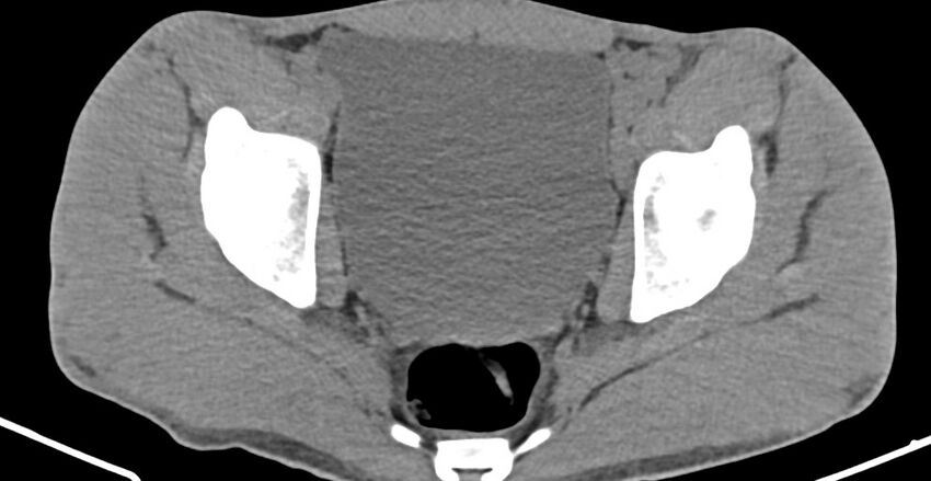 Chronic osteomyelitis (with sequestrum) (Radiopaedia 74813-85822 D 29).jpg
