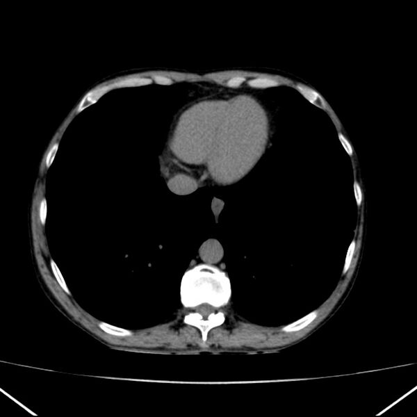 File:Chronic pancreatitis (Radiopaedia 23132-23172 Axial non-contrast 1).jpg
