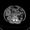 Chronic pancreatitis (Radiopaedia 23132-23172 Axial non-contrast 40).jpg