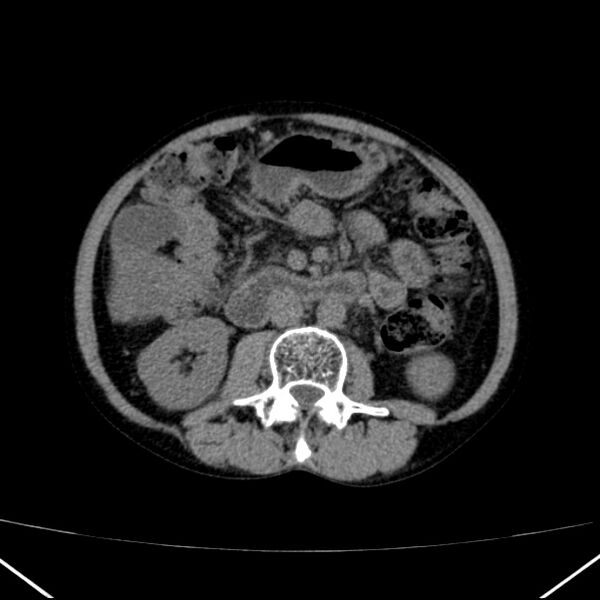 File:Chronic pancreatitis (Radiopaedia 23132-23172 Axial non-contrast 40).jpg