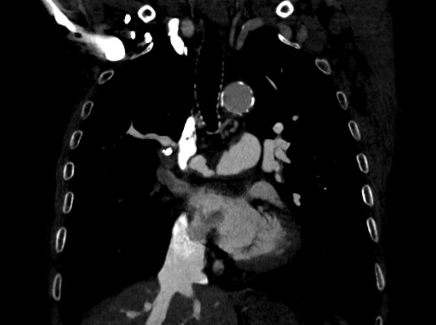 Chronic pulmonary embolism (Radiopaedia 91241-108843 A 49).jpg