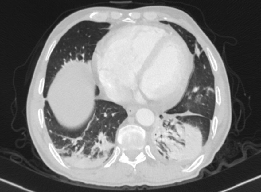 Chronic pulmonary embolism with bubbly consolidation (Radiopaedia 91248-108850 Axial lung window 117).jpg