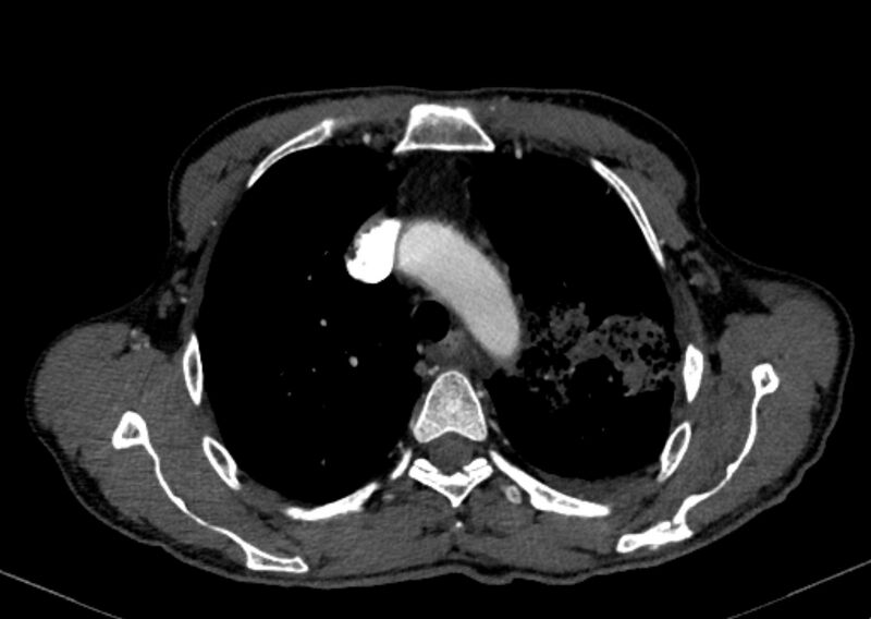 File:Chronic pulmonary embolism with bubbly consolidation (Radiopaedia 91248-108850 C+ arterial phase 32).jpg