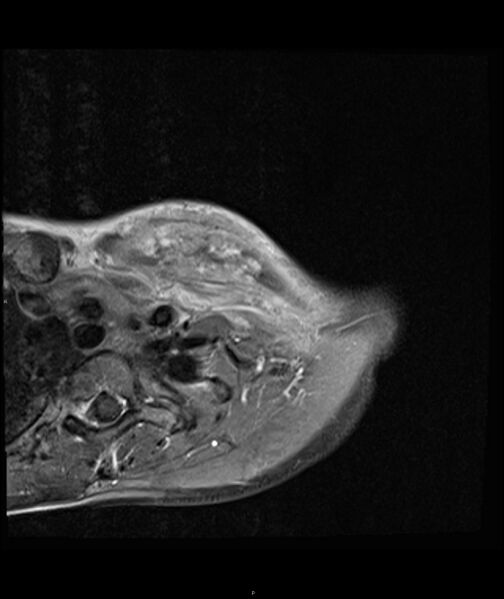 File:Chronic reactive multifocal osteomyelitis (CRMO) - clavicle (Radiopaedia 56406-63071 Axial T1 C+ fat sat 7).jpg