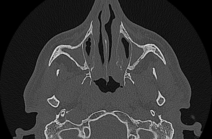 Chronic rhinosinusitis (Radiopaedia 65079-74075 Axial bone window 23).jpg