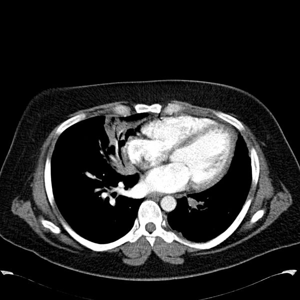 File:Chronic thromboembolic pulmonary hypertension (CTEPH) (Radiopaedia 74597-85531 Axial C+ CTPA 31).jpg