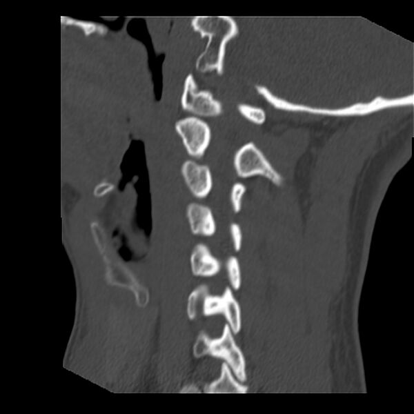 File:Clay-shoveler fracture (Radiopaedia 22568-22590 Sagittal bone window 13).jpg