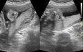 Cleft lip - antenatal ultrasound (Radiopaedia 46761).PNG