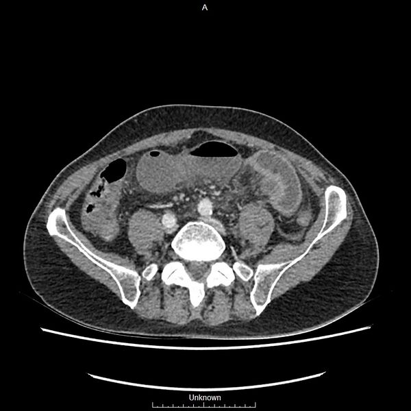 File:Closed loop bowel obstruction and ischemia (Radiopaedia 86959-103180 A 57).jpg