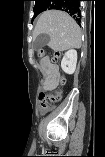 File:Closed loop bowel obstruction and ischemia (Radiopaedia 86959-103180 C 53).jpg